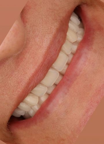 Augšžokļa visu zobu atjaunošana - 4 implanti + pagaidu akrila konstrukcija ar titāna karkasu