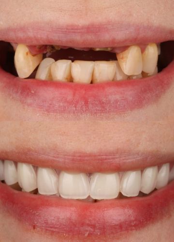 Augšžokļa visu zobu atjaunošana (4 implanti + pagaidu konstrukcija)
