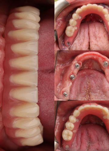 Apakšžokļa zobu rindas atjaunošana ar 6 implantiem un pagaidu (fiksētu) akrila protēzi. Augšžoklī jaunas totālā protēze.